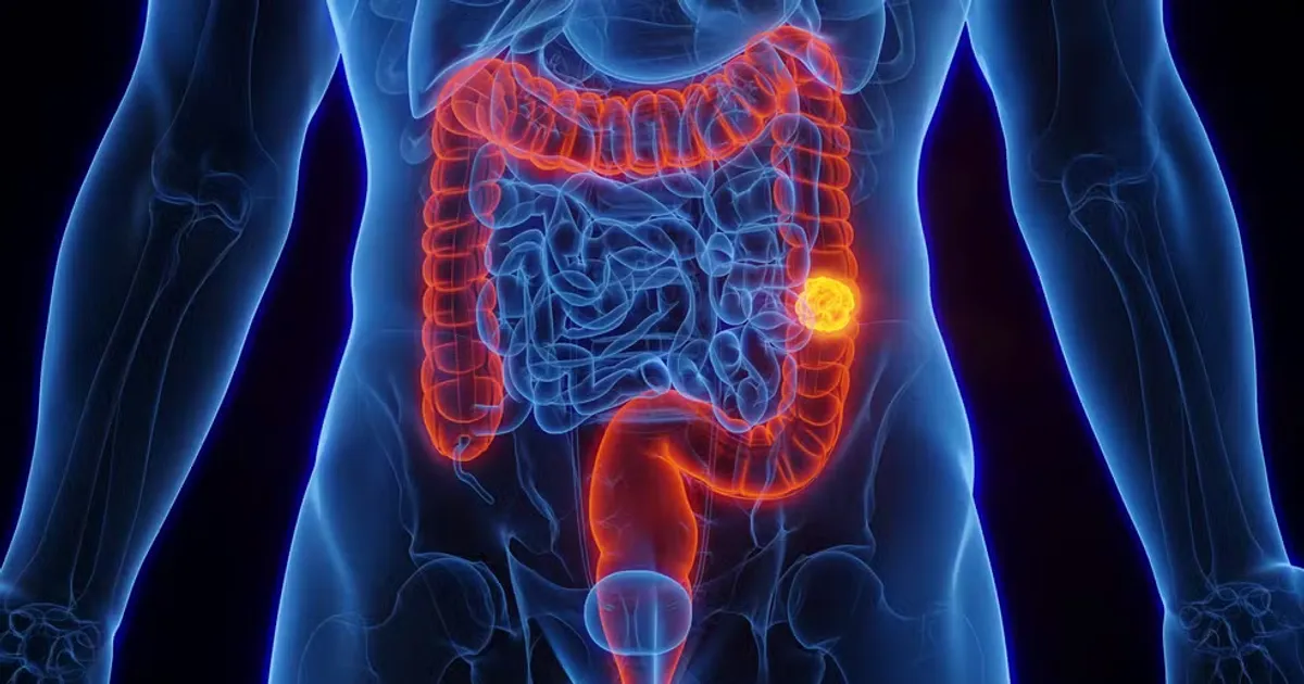 Câncer de Intestino: SUS Passa a Detectar Antes dos Sintomas. E o Seu Plano?